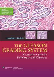 The Gleason Grading System A Complete Guide for Pathologist and Clinicians